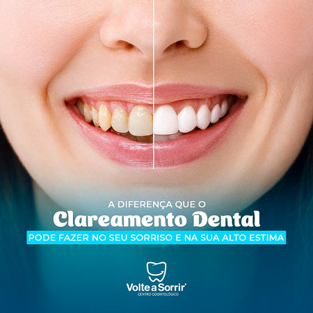 Clareamento dental